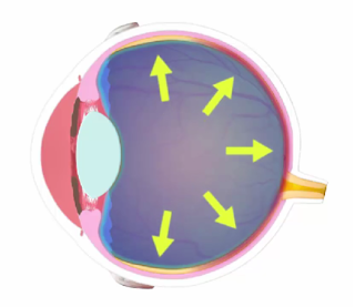 Schéma de la pression intraoculaire endommageant les vaisseaux sanguins